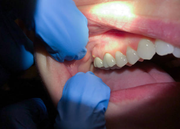 Best Emergency Treatment for Oral Infections in Elwood, IN
