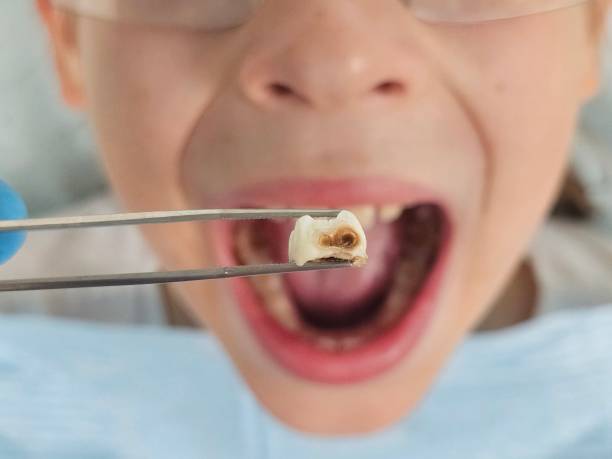 Best Emergency Care for Gum Disease in Elwood, IN
