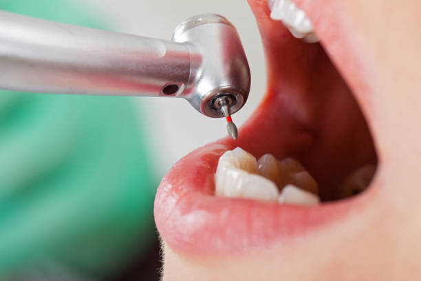 Best Emergency Wisdom Tooth Extraction in Elwood, IN